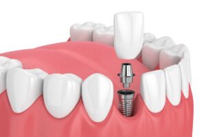 Dental Implants Near Me - Wollongong - Ambience Dental