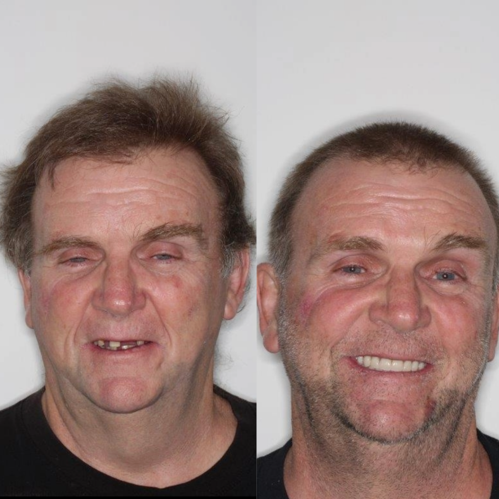 Before and After All-On-4 Treatment and Ambience Dental
